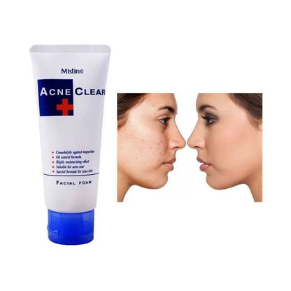 Mistine Acne Clear Facial Foam 85ml