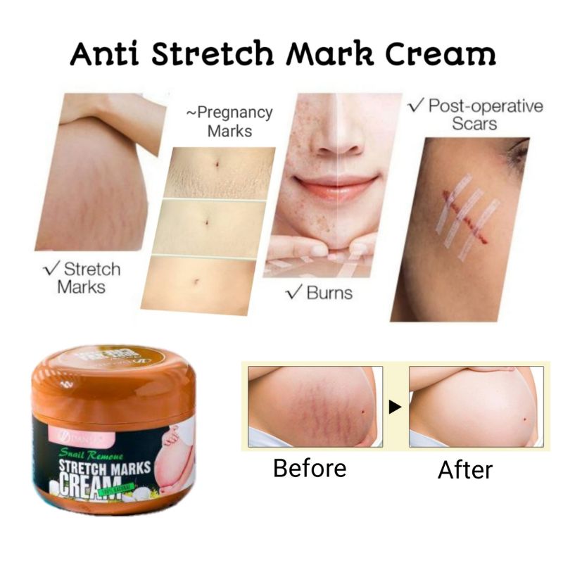 Snail Stretch Mark Cream Remove Stretch Mark